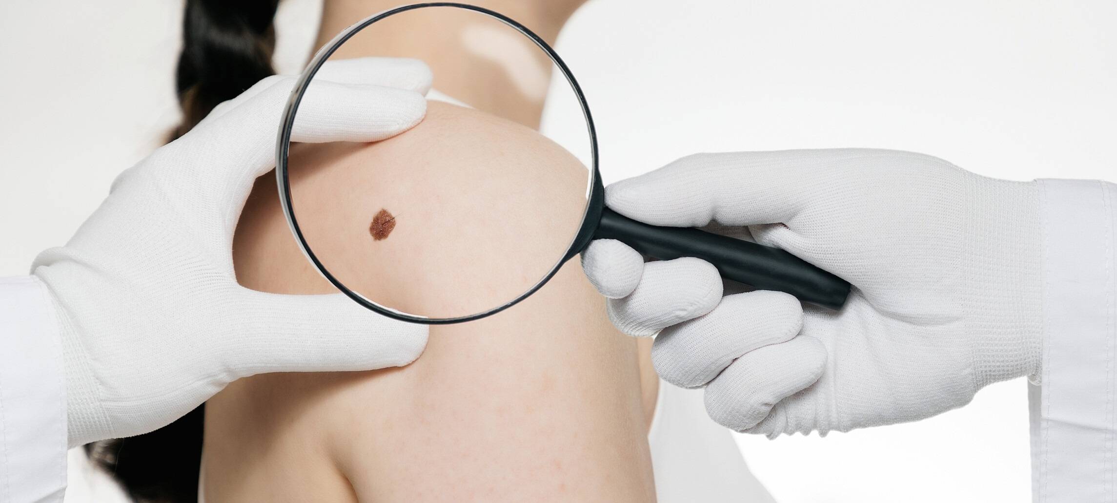 Werbung für Hautkrebsfrüherkennung