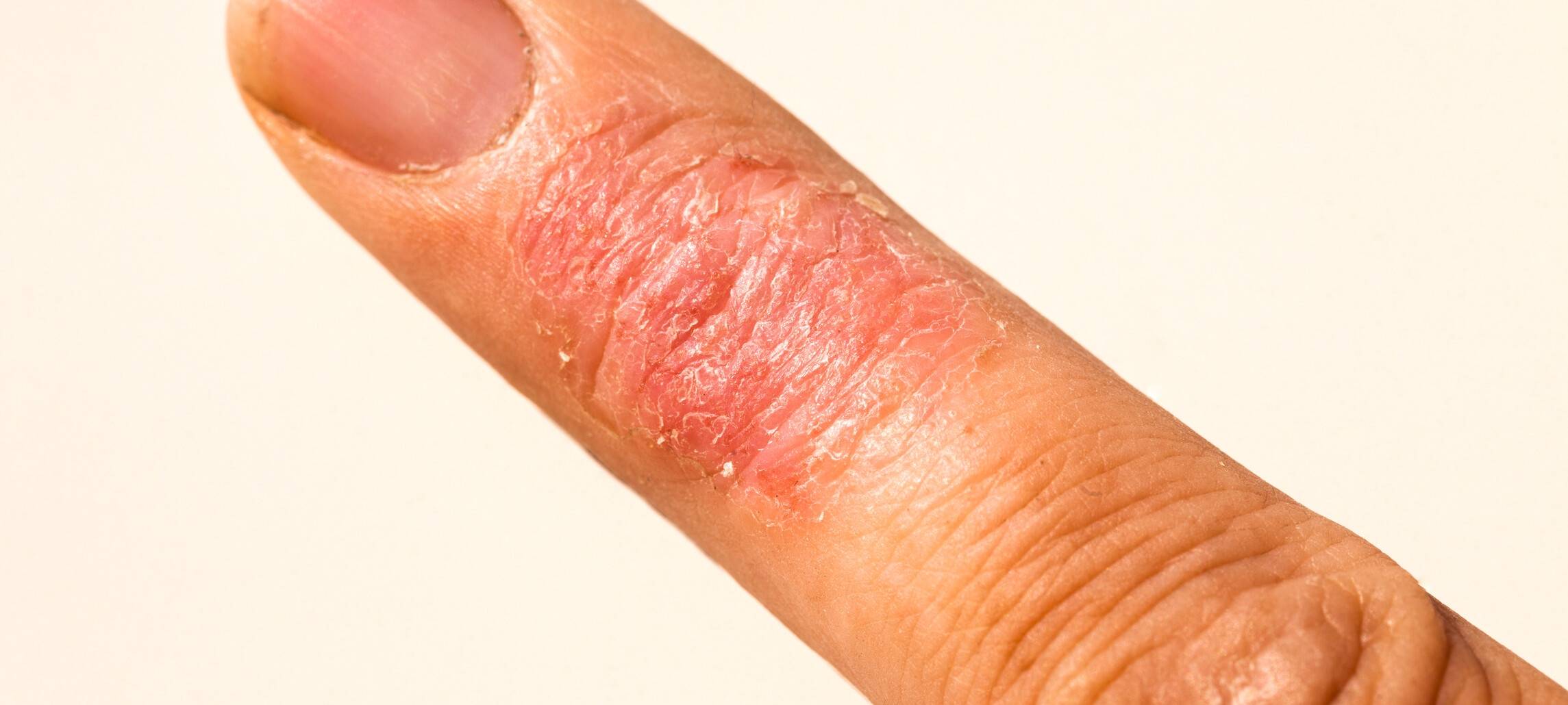 Winterallergien im Sauerland