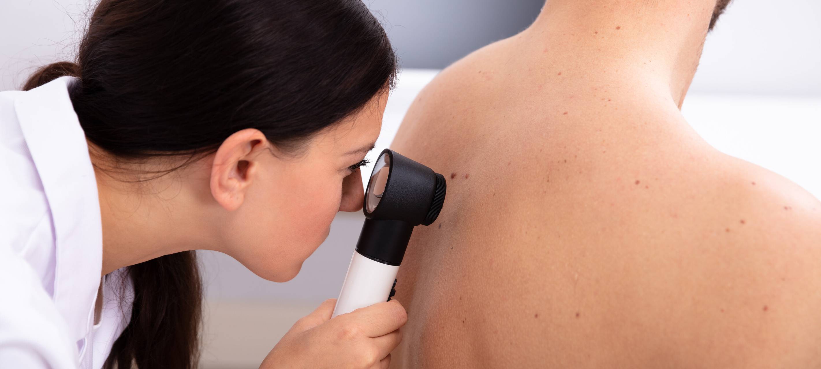 Menschen im Sauerland lassen sich selten auf Hautkrebs testen