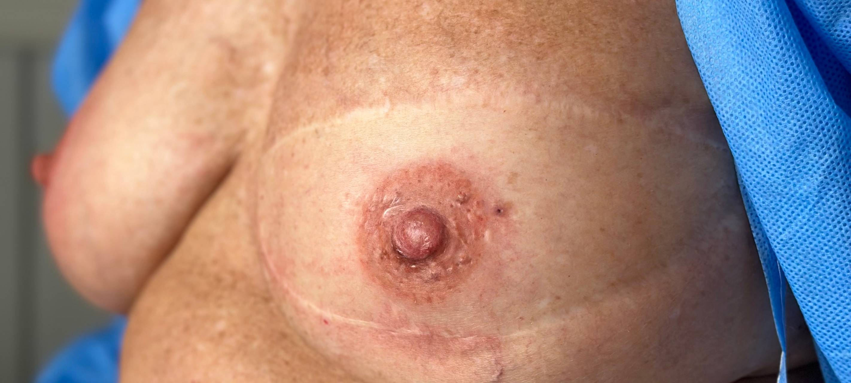 Zum Nachhören: Angebote für Brustkrebs-Erkrankte