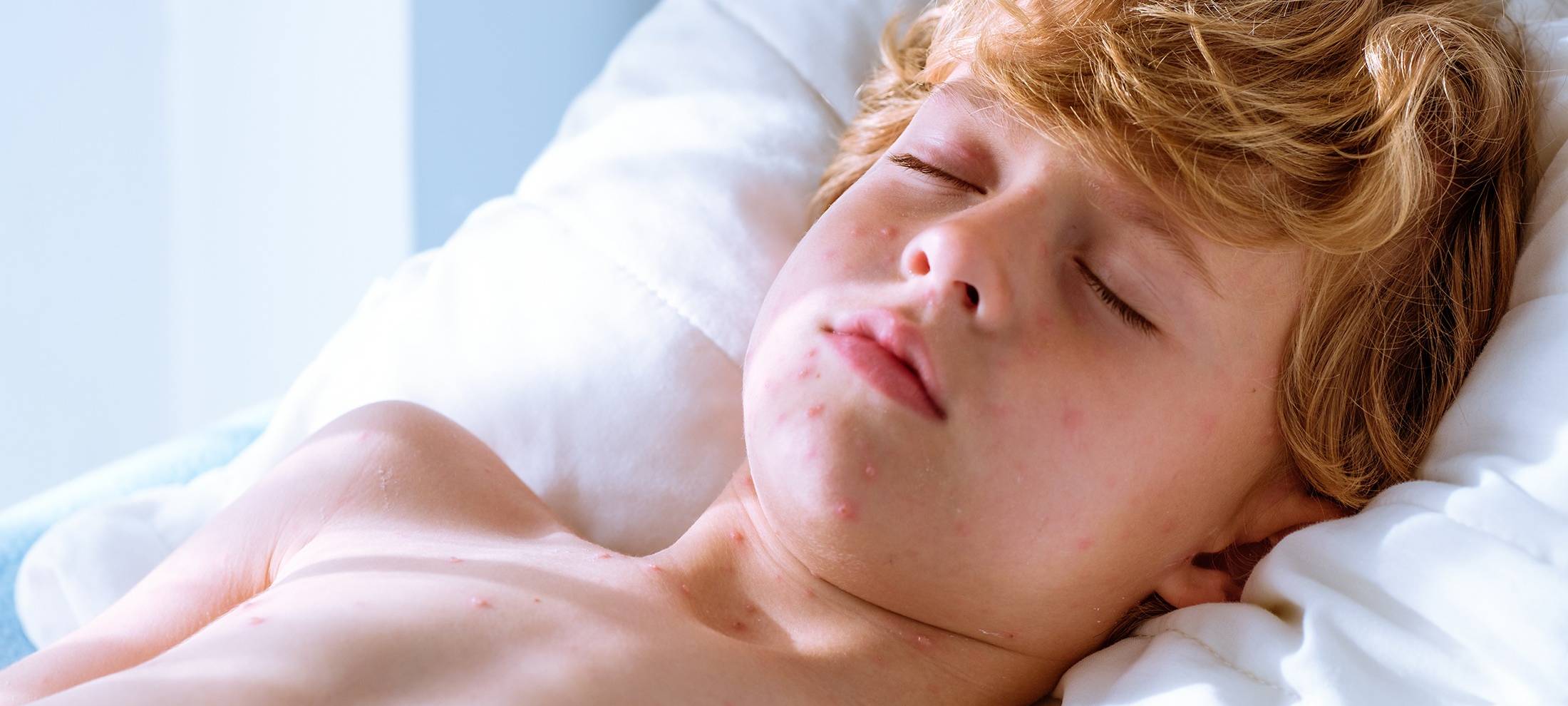 Wieder mehr Windpockenfälle im Sauerland