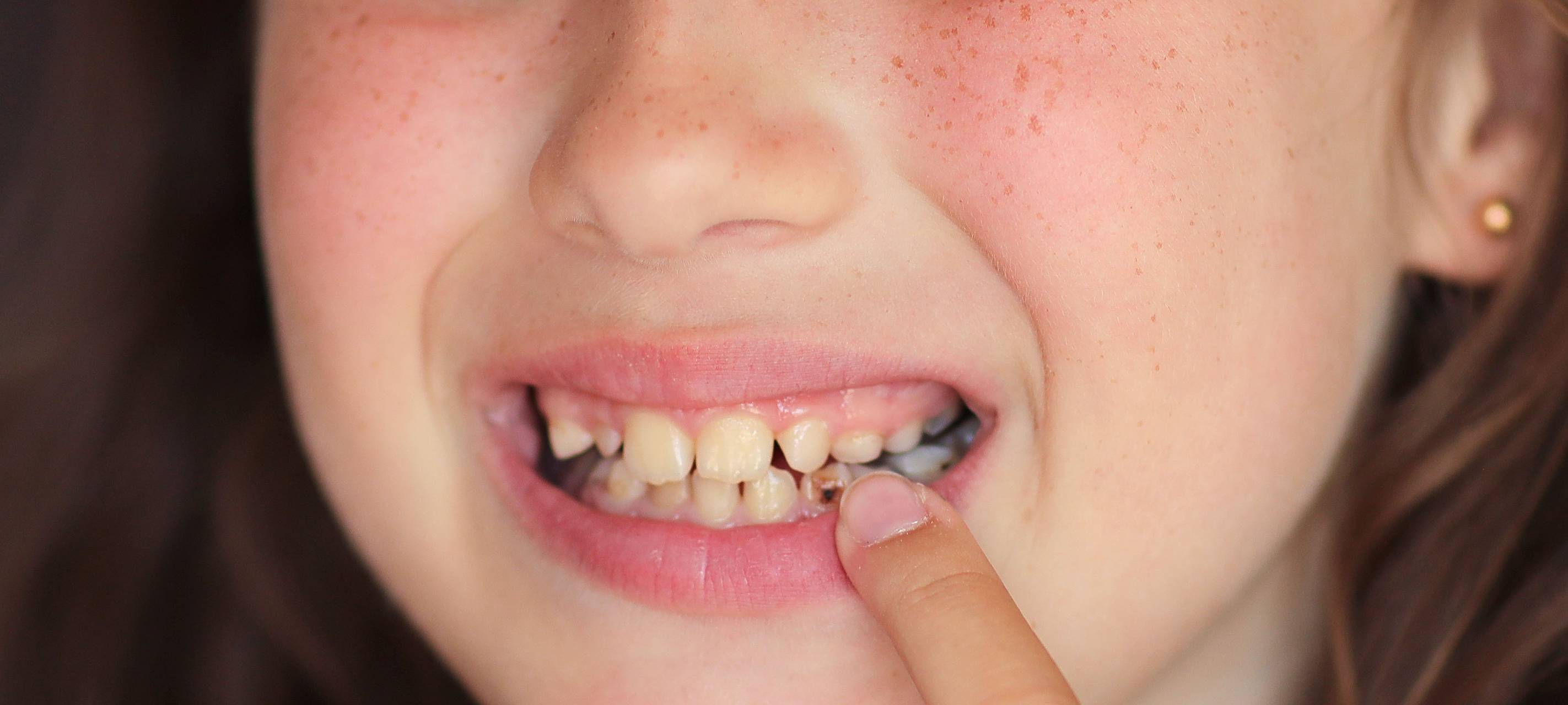 Sauerland: schlechte Zahnhygiene bei Kindern
