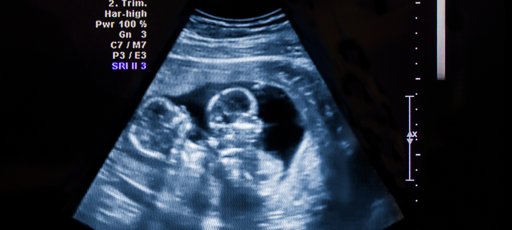 Weniger Zwillinge im HSK zur Welt gekommen