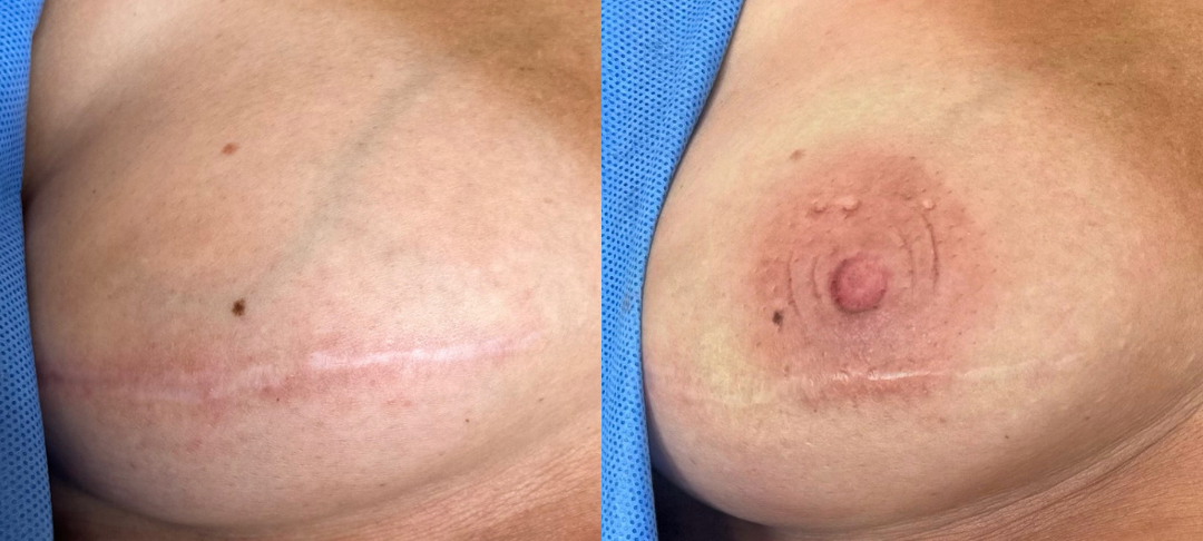 Zum Nachhören: Angebote für Brustkrebs-Erkrankte